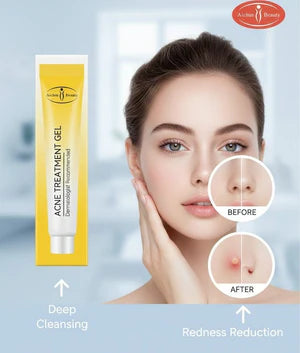 Aichun Beauty - Acne Treatment Gel